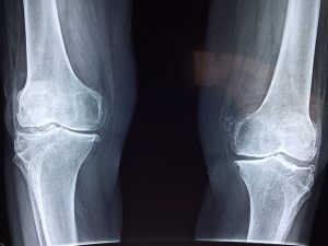 Ból kolana – przyczyny
